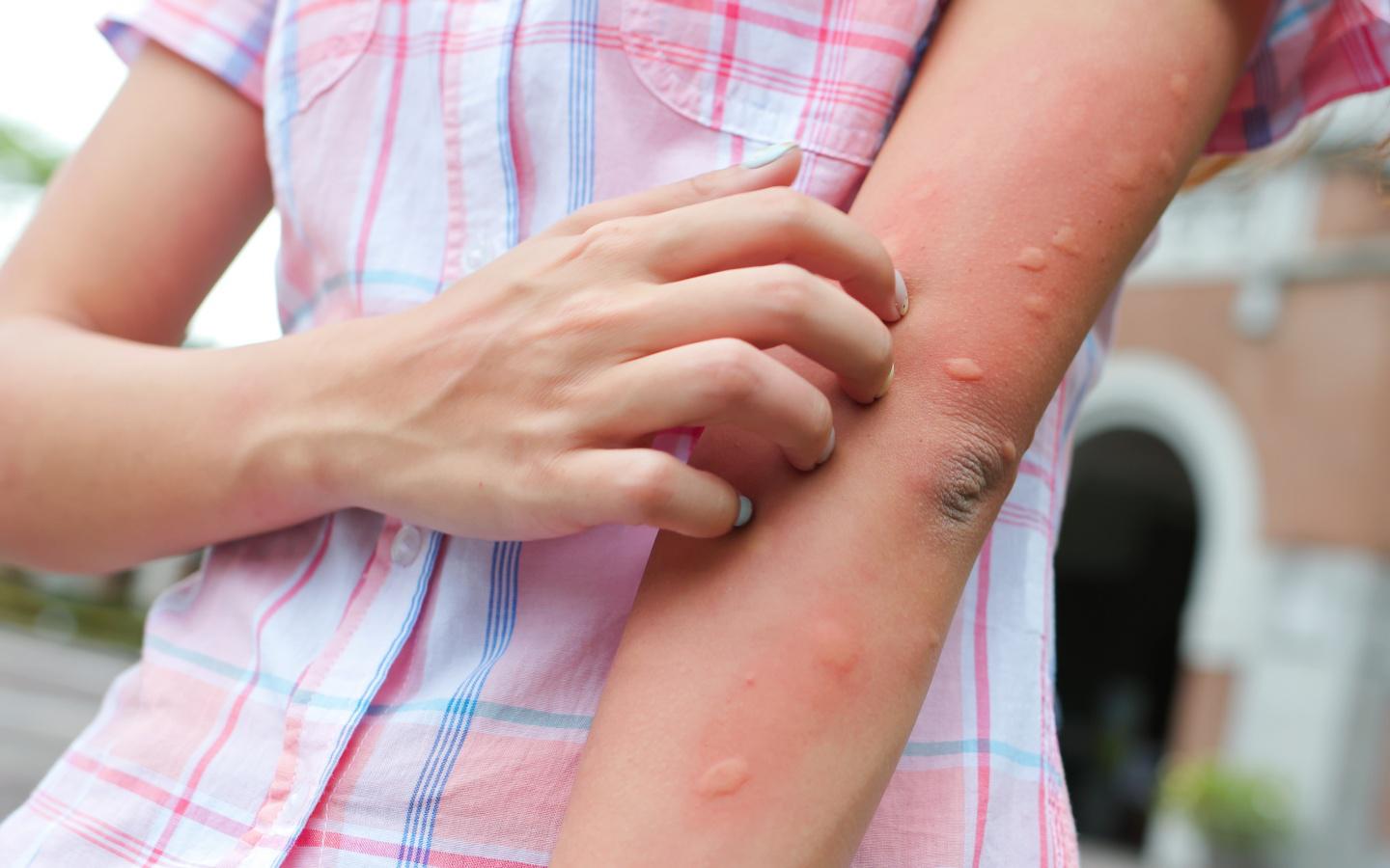 mosquito bite arm scratch