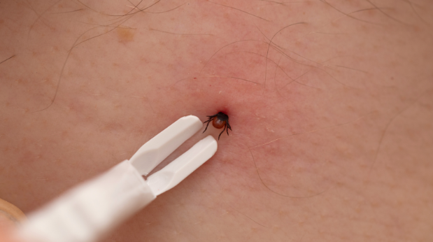 How Do I Know If I’ve Removed The Entire Tick from My Skin?