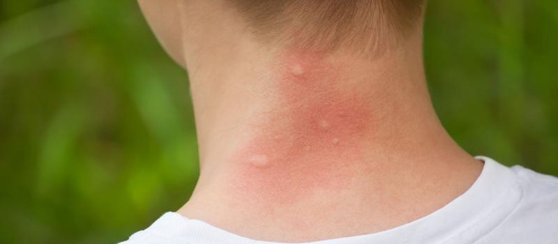 Why Do Mosquitoes Bite Me So Much?
